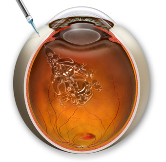 有些病人通过混合疗法,结合光动力疗法﹑玻璃体注射类固醇及抗血管内