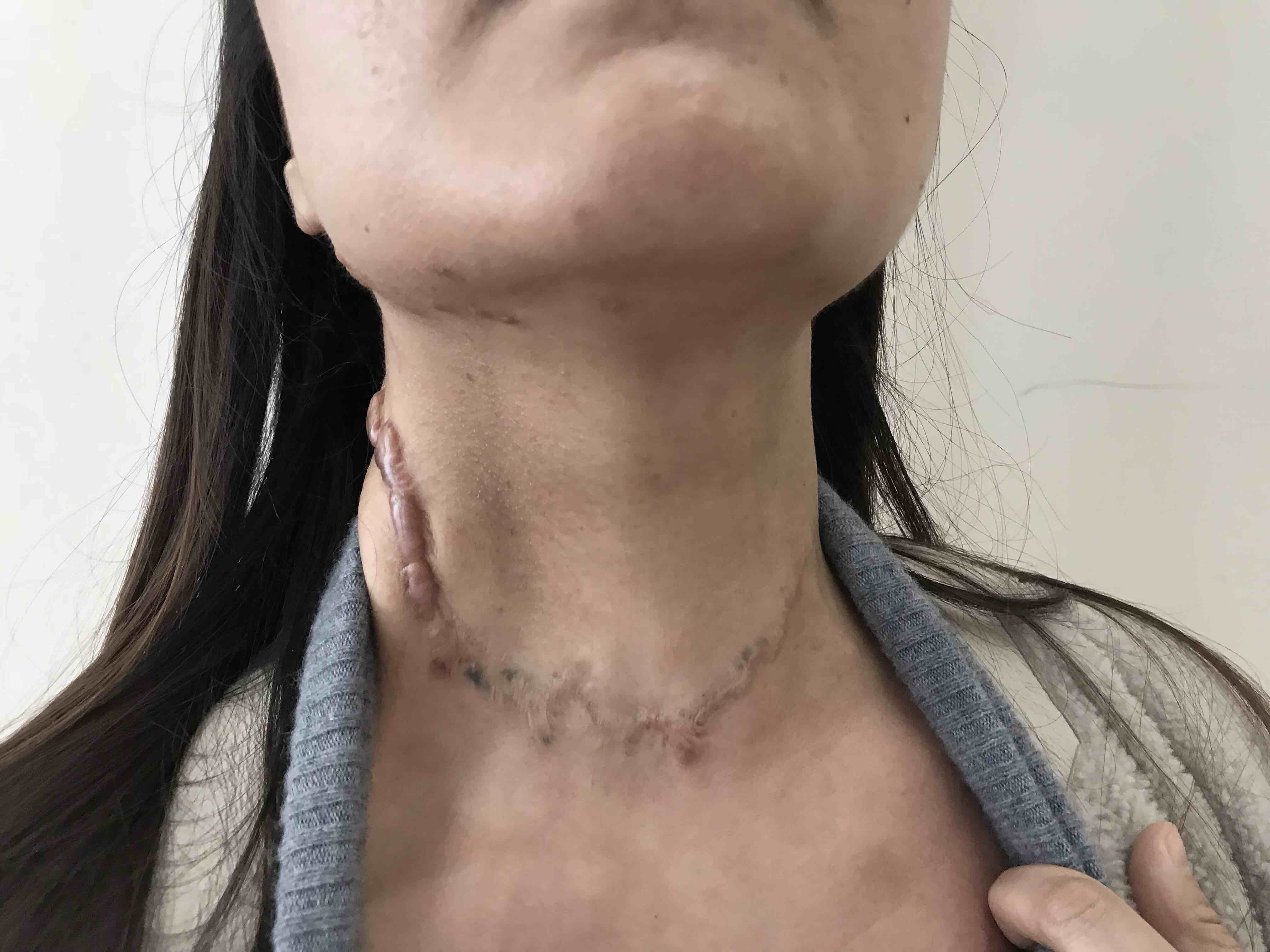 39岁甲状腺癌女患者脖子上的"五刀"之痛-鲁瑶主任医师-爱问医生