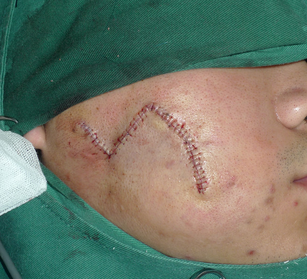 皮瓣手术疤痕图片旋转图片