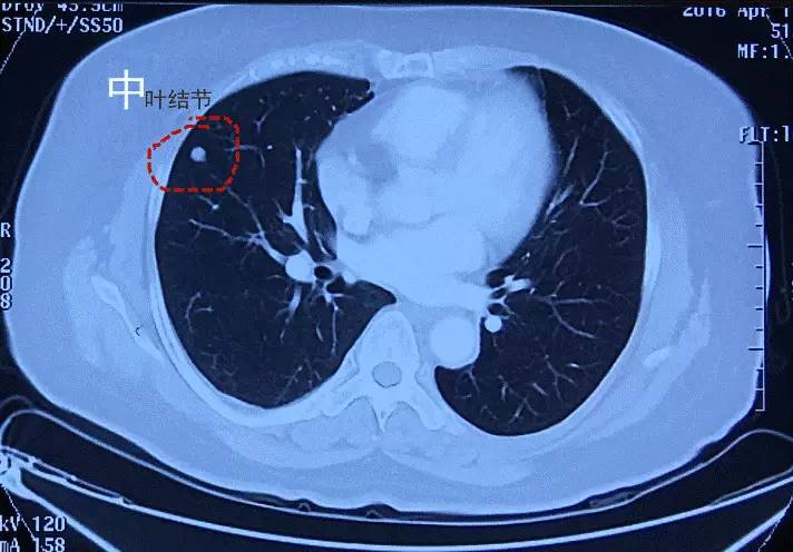 如此結節竟是肺癌