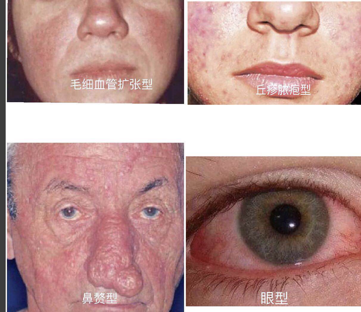 痤疮主要分为四型:红斑毛细血管扩张型,丘疹脓疱型,鼻赘型和眼型4型