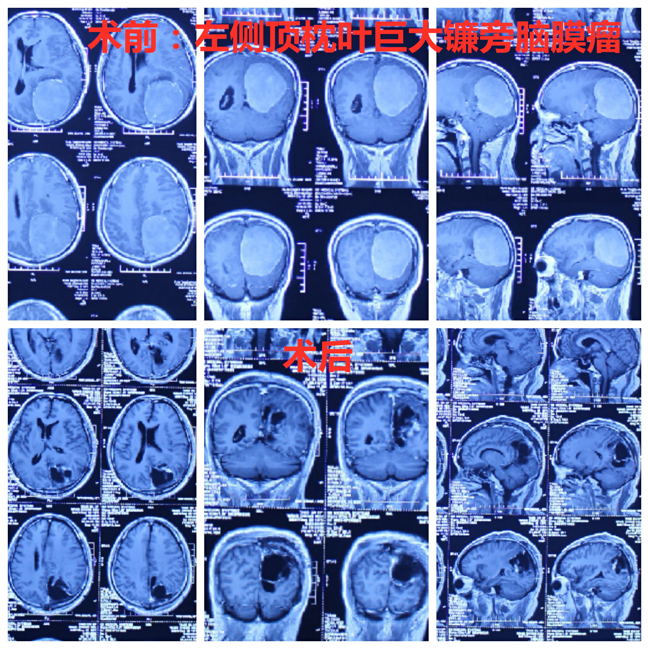 【医疗扶贫】同心同力为"生命接力,巨大顶枕部镰旁脑膜瘤