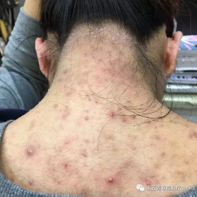 痤疮诊室里关于脸上痘痘的7个常见问题与解答