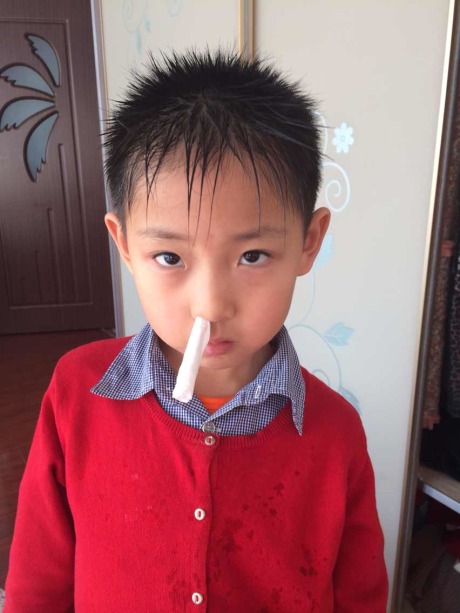 孩子鼻子总出血是怎么回事?/z是什么好方法吗? - 爱问知识人