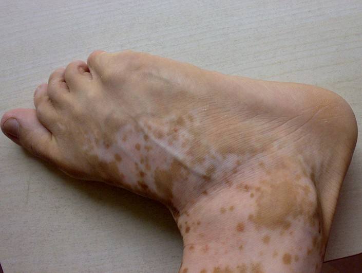 白斑总是缠着你怎么办?这3个坏习惯,你若改了,便是晴天