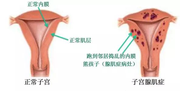 子宮肌瘤,子宮腺肌症,子宮內膜異位症都有些什麼危害?