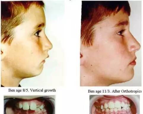 你还在用嘴呼吸吗?小心毁掉的不仅仅是颜值