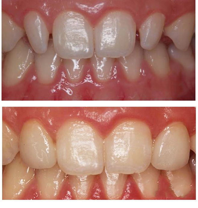 ②关闭轻到中度的前牙间隙▼③牙体排列异常,如牙体轻度扭转或舌侧