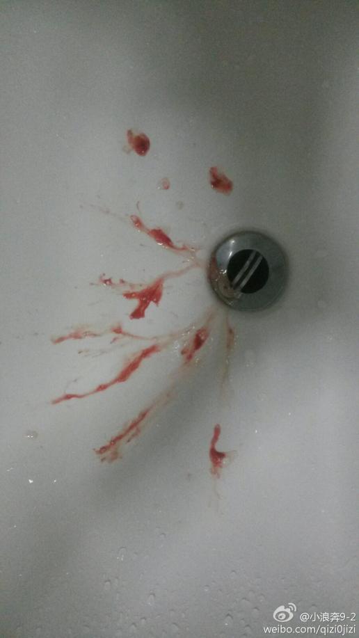 医院吐血真实照片图片