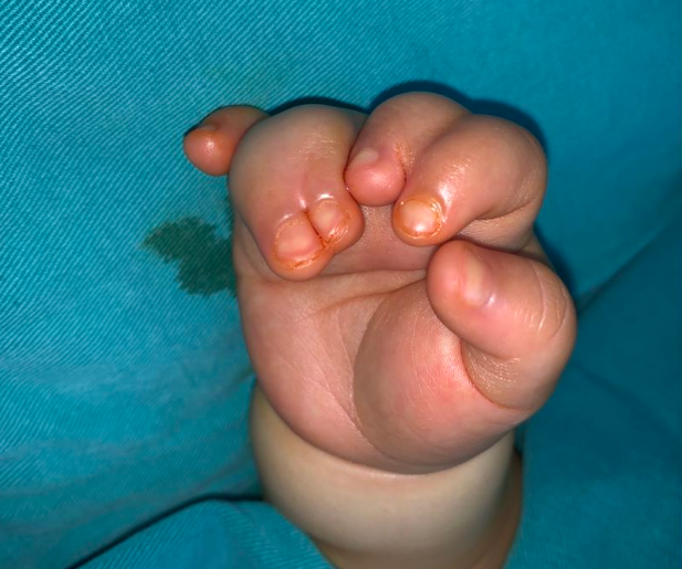 并指伴多指术后孩子的手指外形和功能很不错