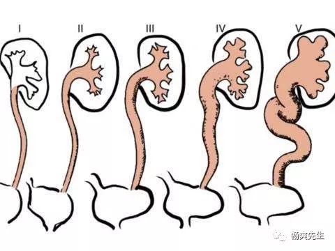 双腔导尿管结构图图片