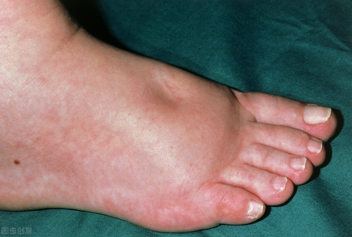 身体有这5个表现,说明肾友病情正在好转