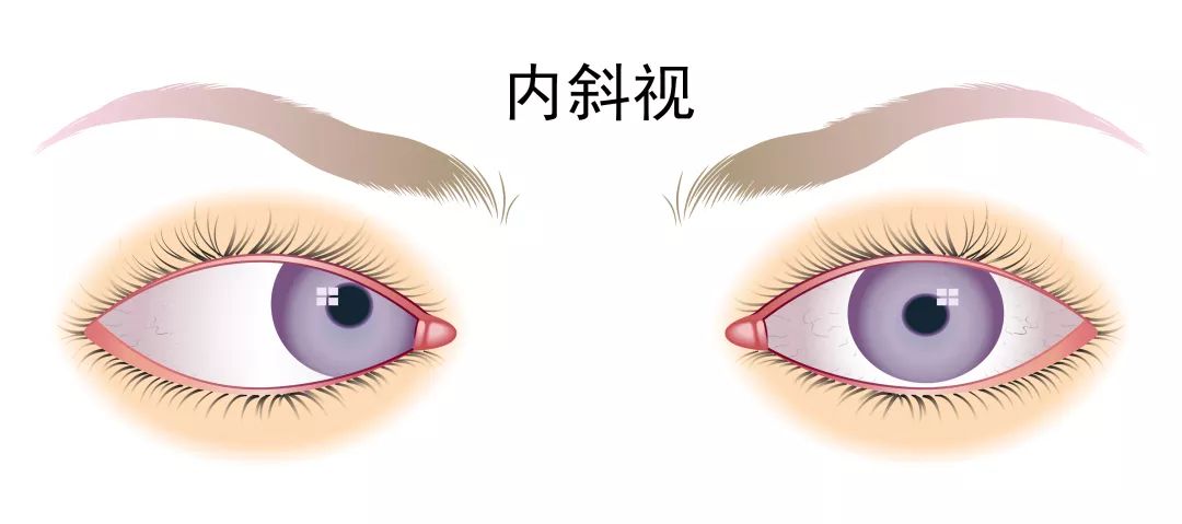 在出生至1岁内发生者称之为先天性内斜视,偏斜角度通常很大.