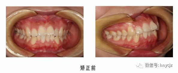 同时牙齿前突,有一定程度的拥挤,不齐