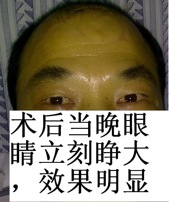 重症肌無力病友微創手術前後真實感受