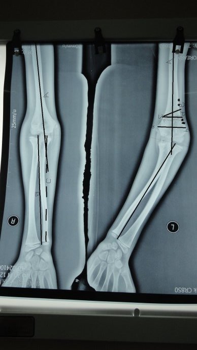 小朋友手臂被车撞变形了似乎另有隐情