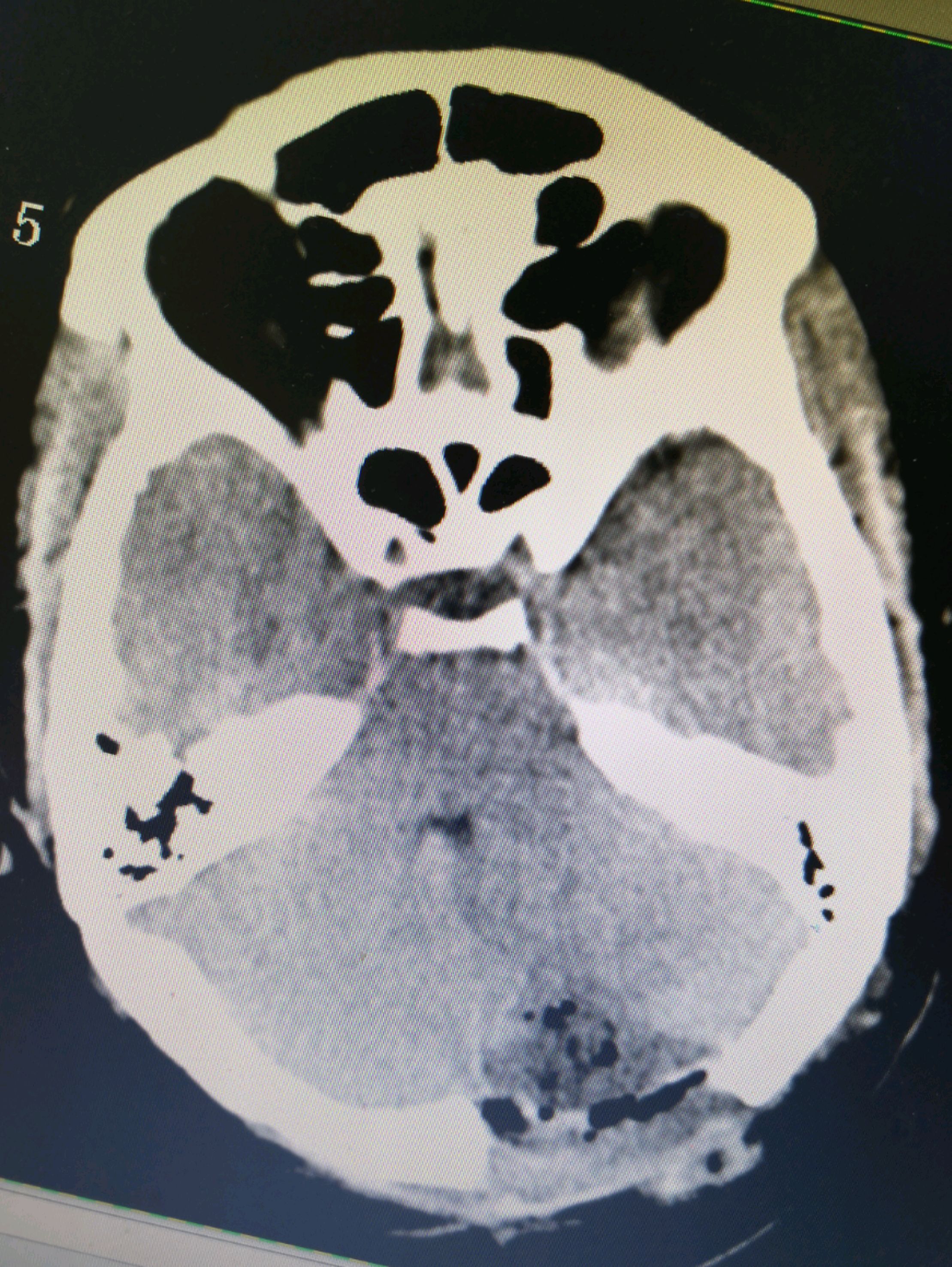 脑膜瘤MRI图片