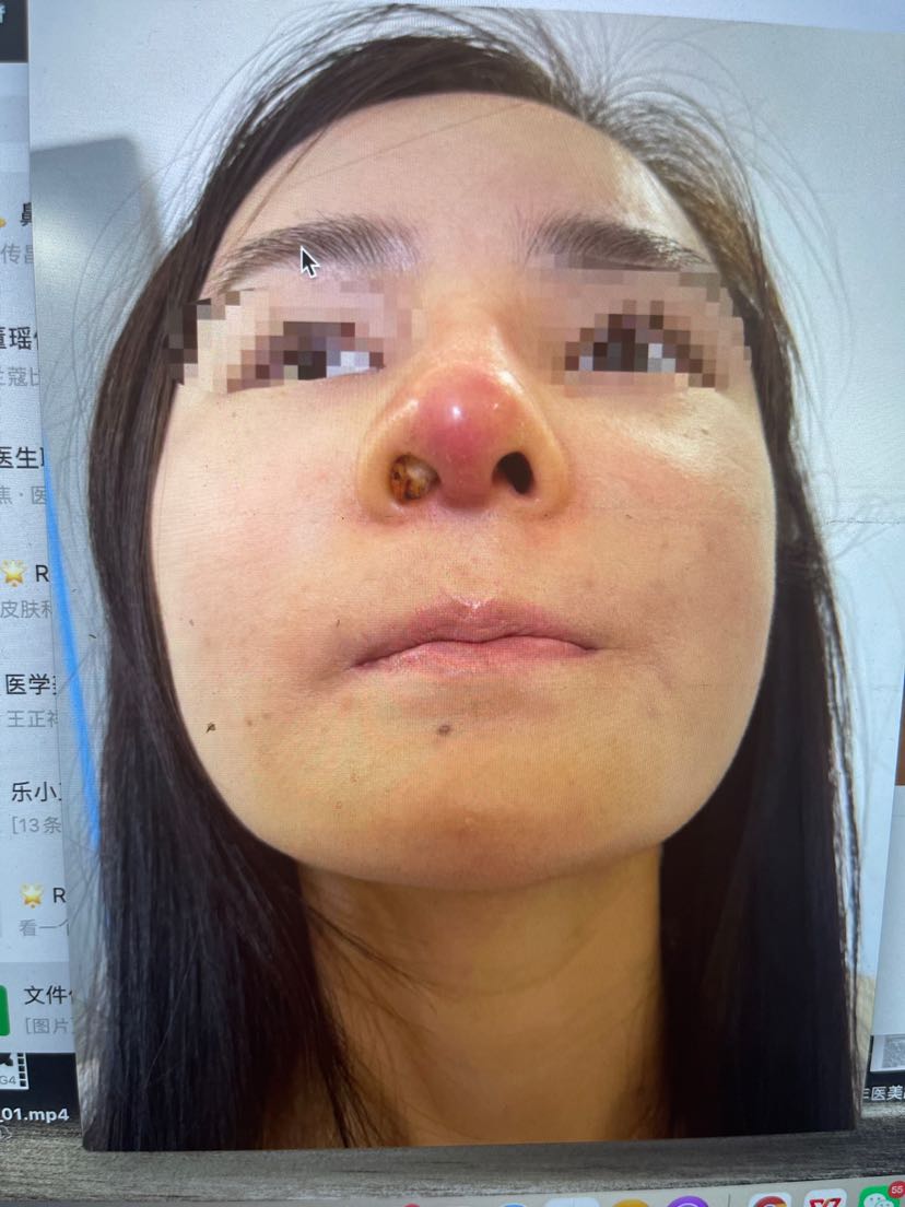 痤疮导致的膨体耳软骨鼻综合感染-刘烨主治医师-爱问医生