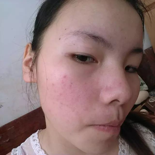 初中生脸上长痘痘怎么办