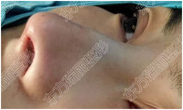 关于异体骨隆鼻,你想知道的都在这里