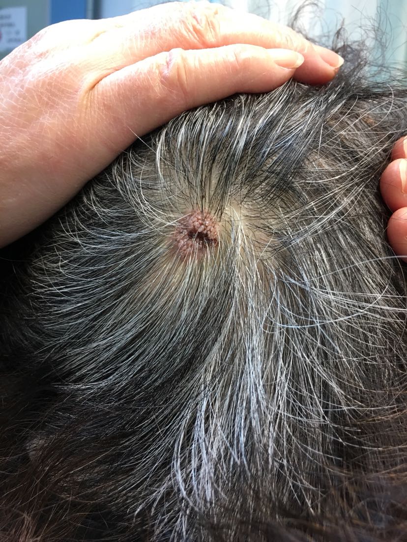 毛发上皮瘤早期图片图片