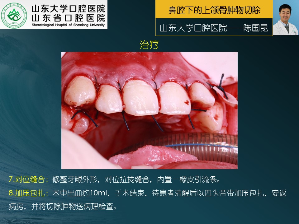 颌面外科手术系列1鼻腔下的上颌骨肿物