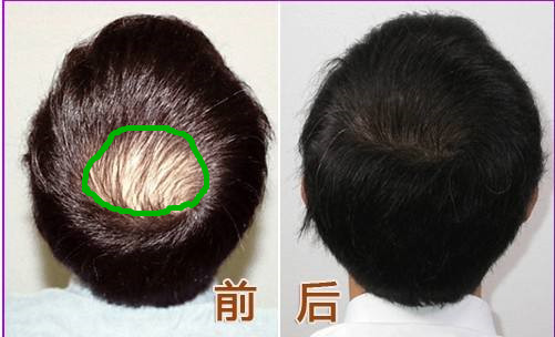 为什么雄脱不适合植发(雄性脱发为什么只脱头顶)