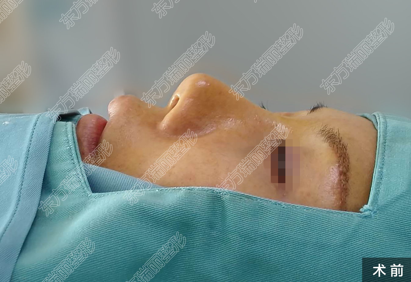 鼻整形手术鼻翼缩小会留疤吗?