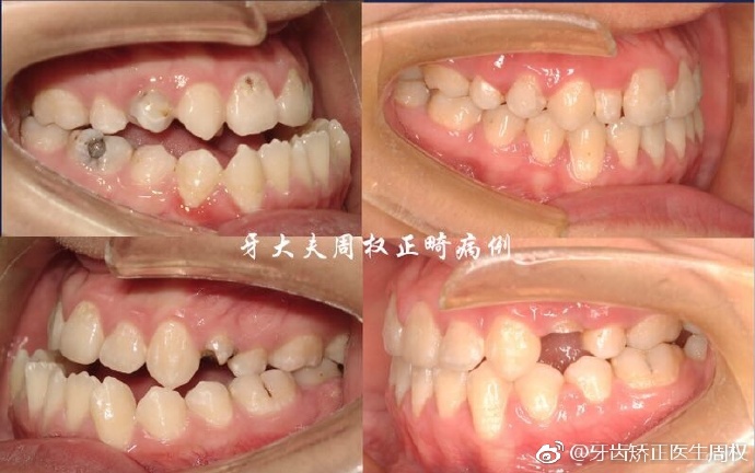 天包地和正常牙齿区别图片
