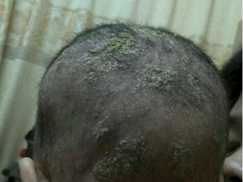 脂溢性皮炎一般不会影响孩子的睡眠及饮食,只有轻微痒感,但头皮上的