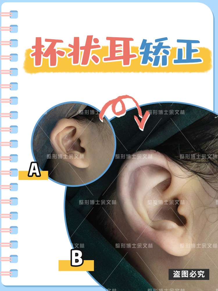 科普杯状耳矫正会不会反弹