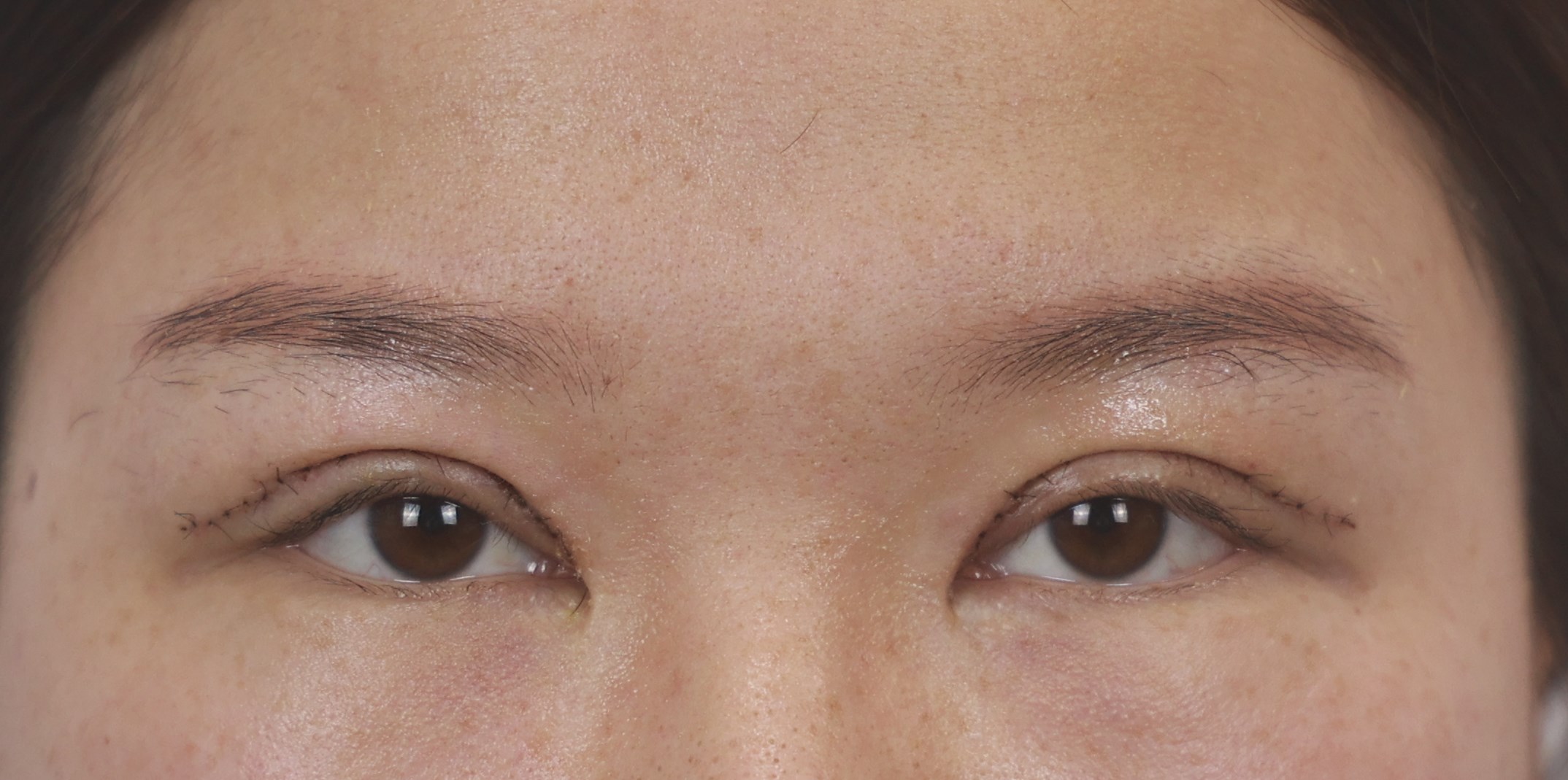 12mm宽平行双眼皮修复开扇形术后17天眼睛变化。 - 知乎