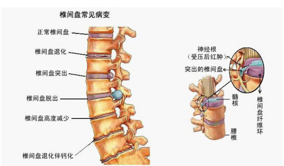 腰间盘具体位置图图片