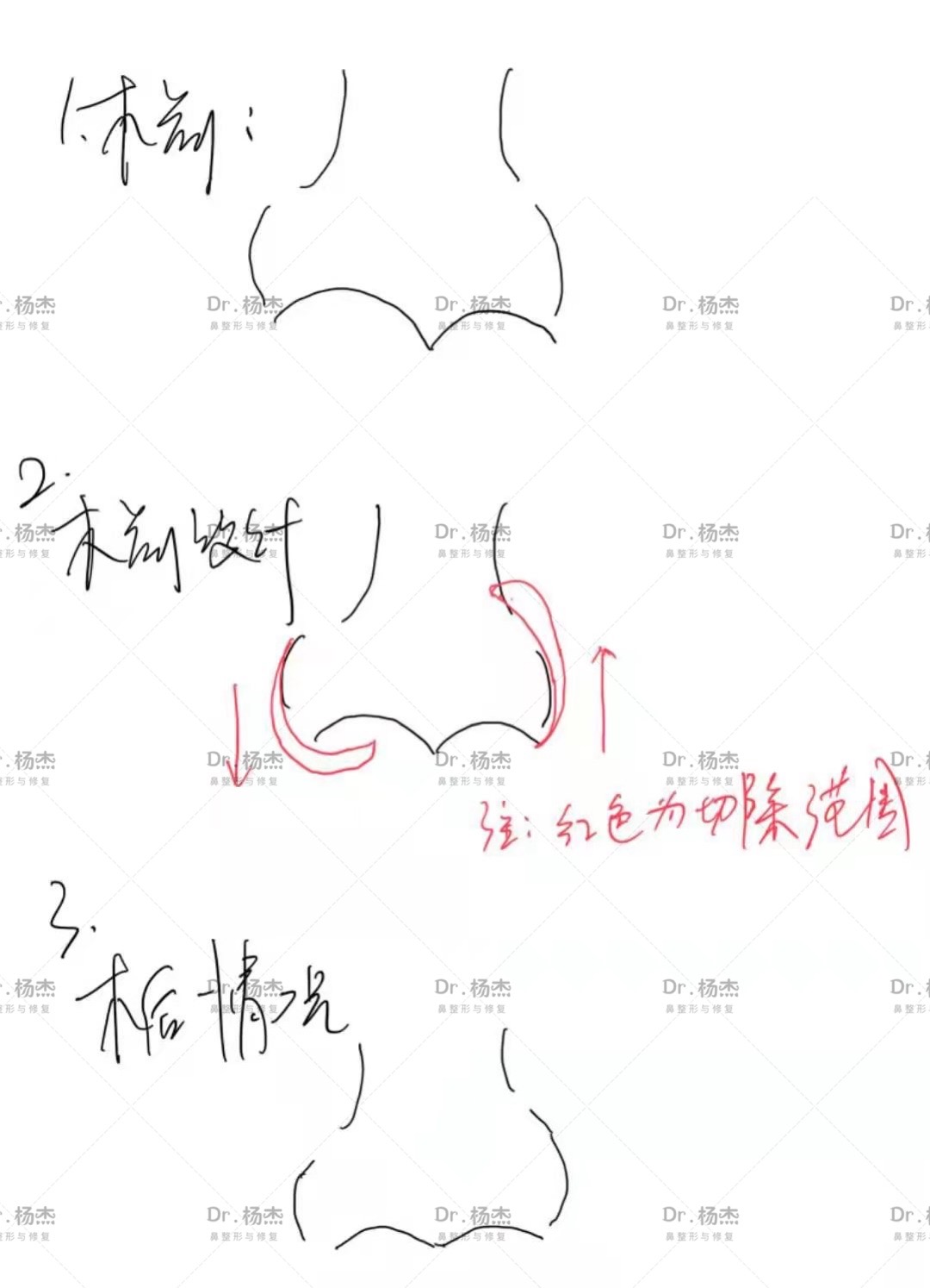 【鼻翼外切疤痕修复+鼻翼调高低】