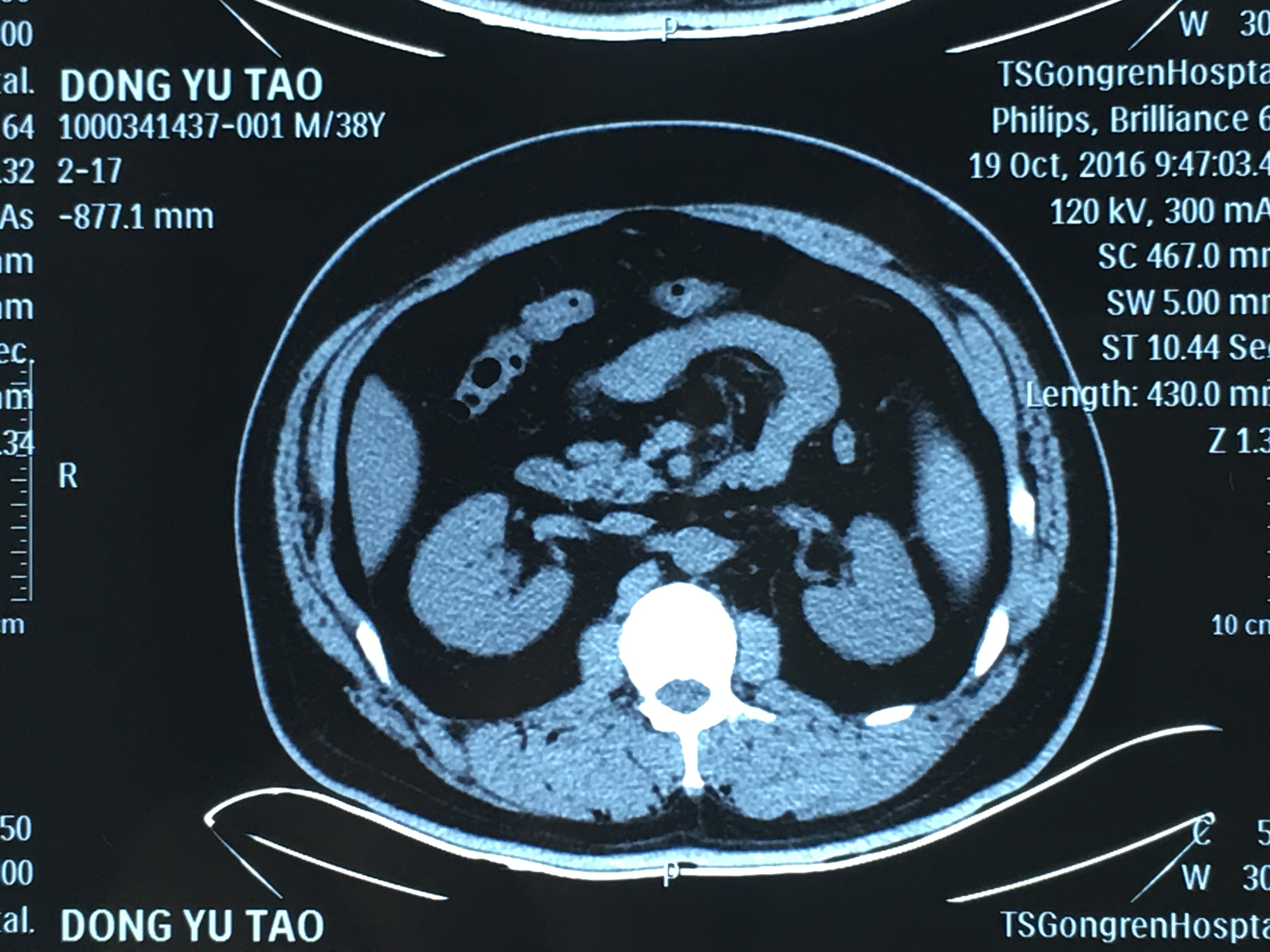 化验及ct值分析,判定结石是尿酸结石,决定实施溶石治疗