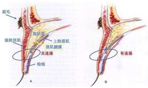 贴双眼皮贴的姑娘，我为什么建议你做双眼皮？