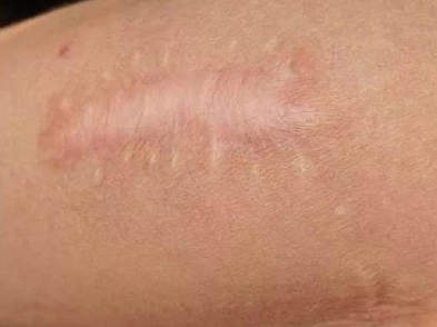 缝针后为什么有的疤痕平整 有的凹凸不平 宋红霞 爱问医生