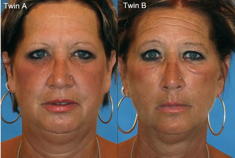 皮肤老化的原因,除了紫外线和衰老,有一个你绝对想不到