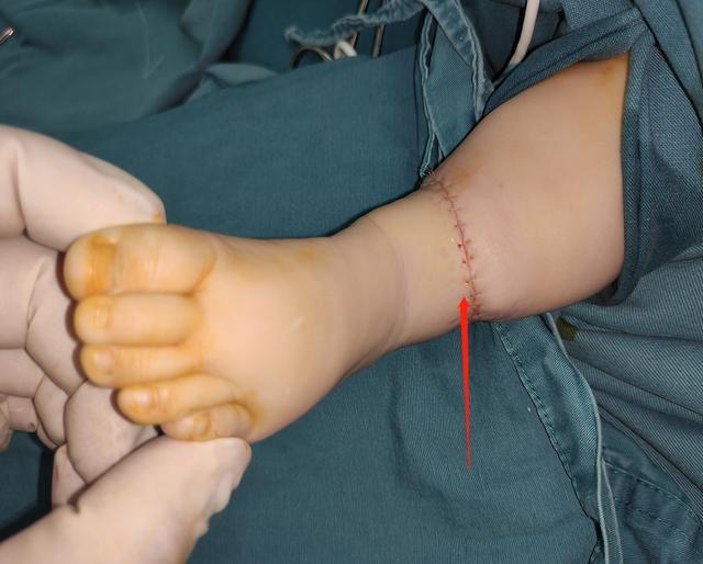 上周刚给一个束带综合征的宝宝做了手术,这个宝宝的束带在当地做了