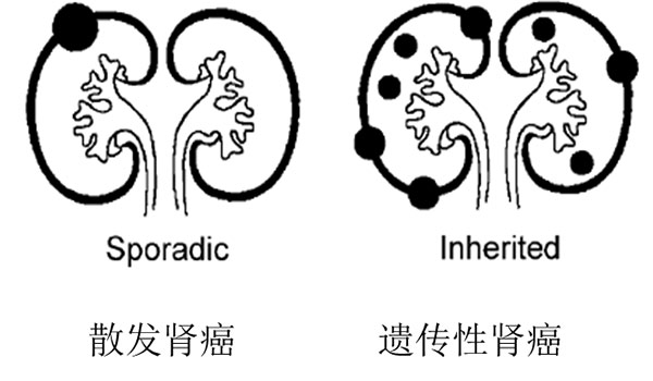 遗传性肾病 新浪（移动端）