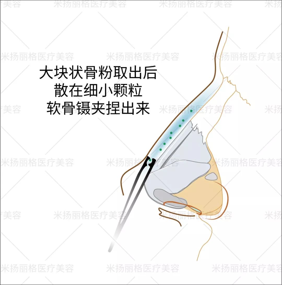 隆鼻修复骨粉隆鼻安全吗后遗症都有哪些