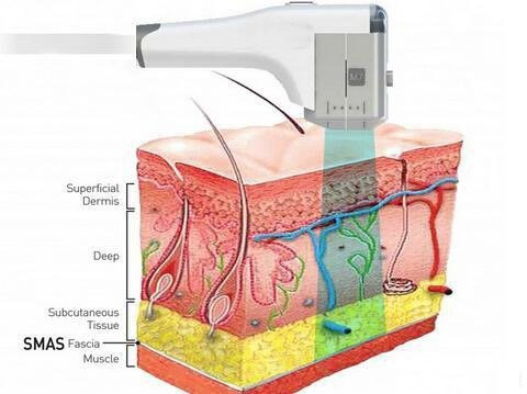超声刀作用原理