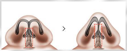 隆鼻科普 什么是鼻小柱延长术?