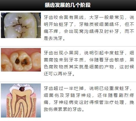 牙齿洞型分类图片