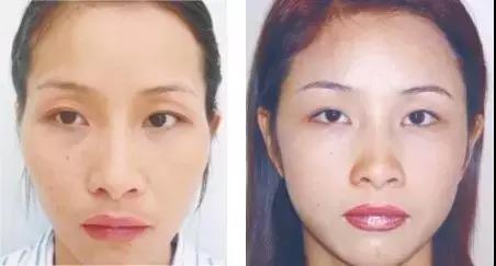 太 阳 穴 凹 陷     太阳穴在面相学中被称为夫妻宫 太阳穴凹陷