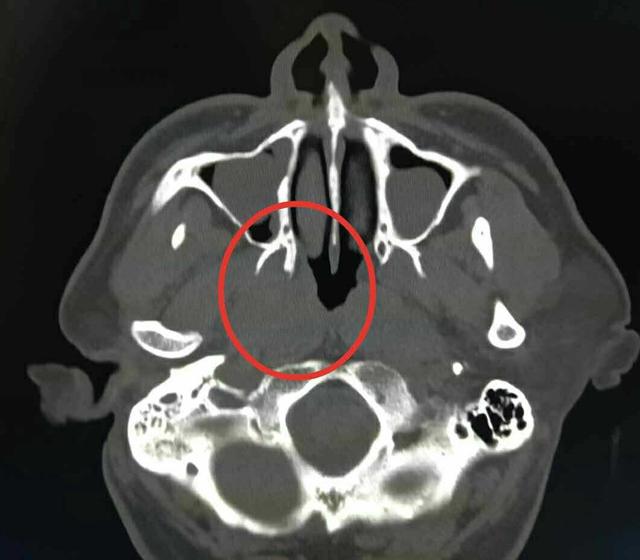 ct上鼻咽癌的表现并不明显磁共振下鼻咽部肿瘤清晰显示出来鼻咽部位于