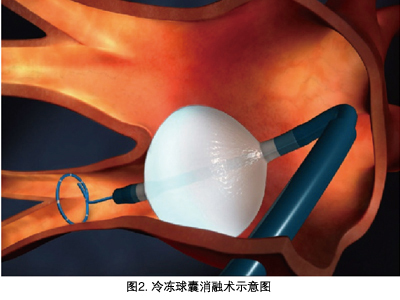 进行首次消融的患者随机分为射频消融组,冷冻球囊消融组和联合消融组