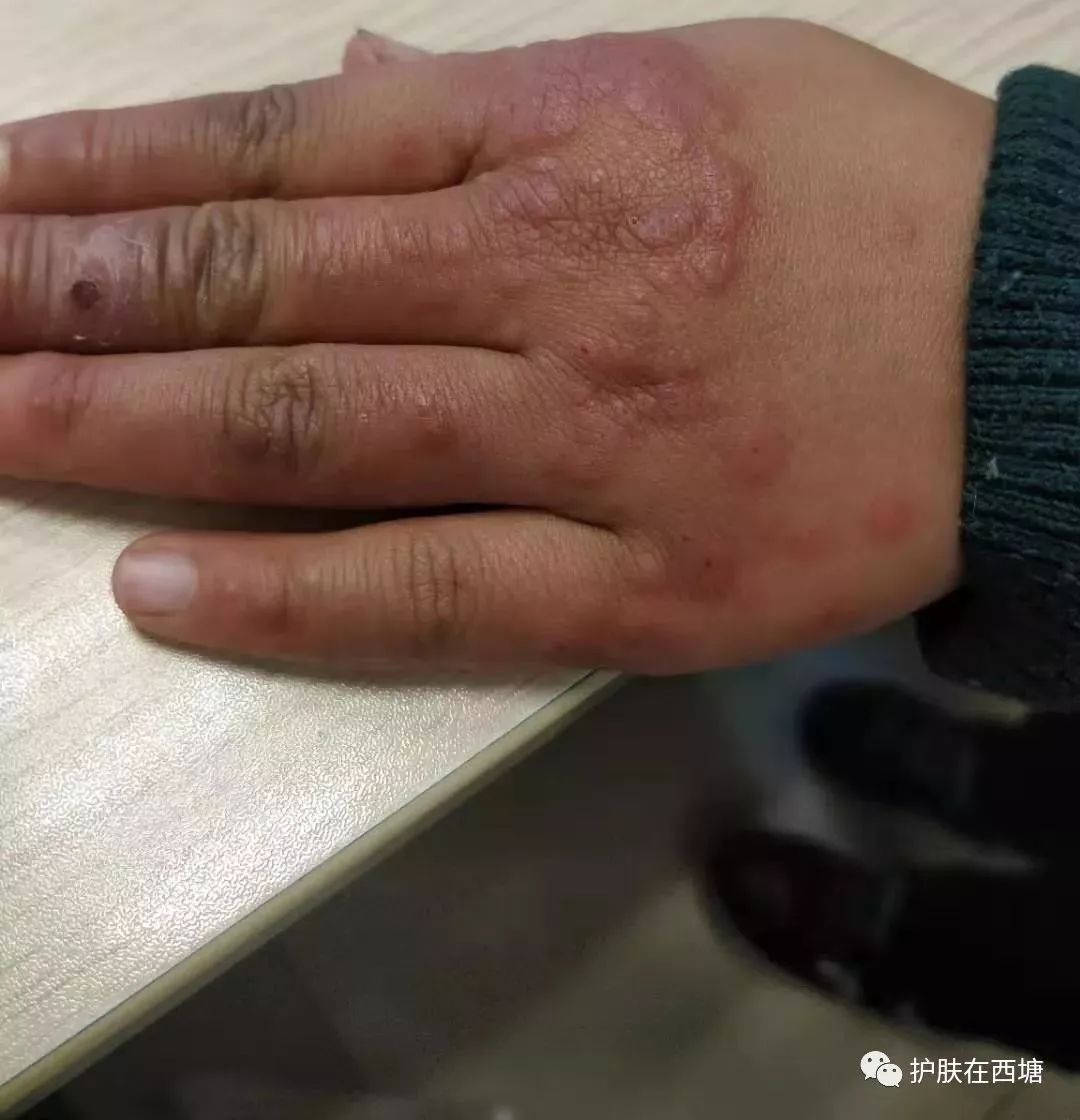 别把寒冷性多形红斑误认为冻疮