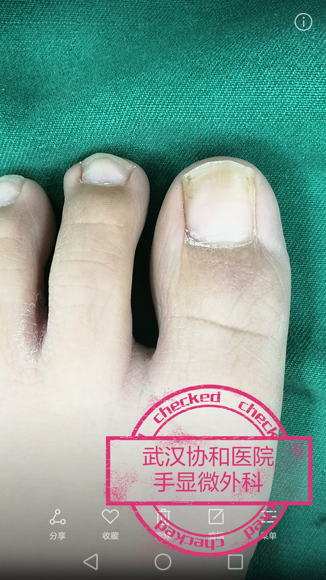 嵌甲是非常常见的疾病,虽然是个小问题, 但是它依然对患者造成了严重