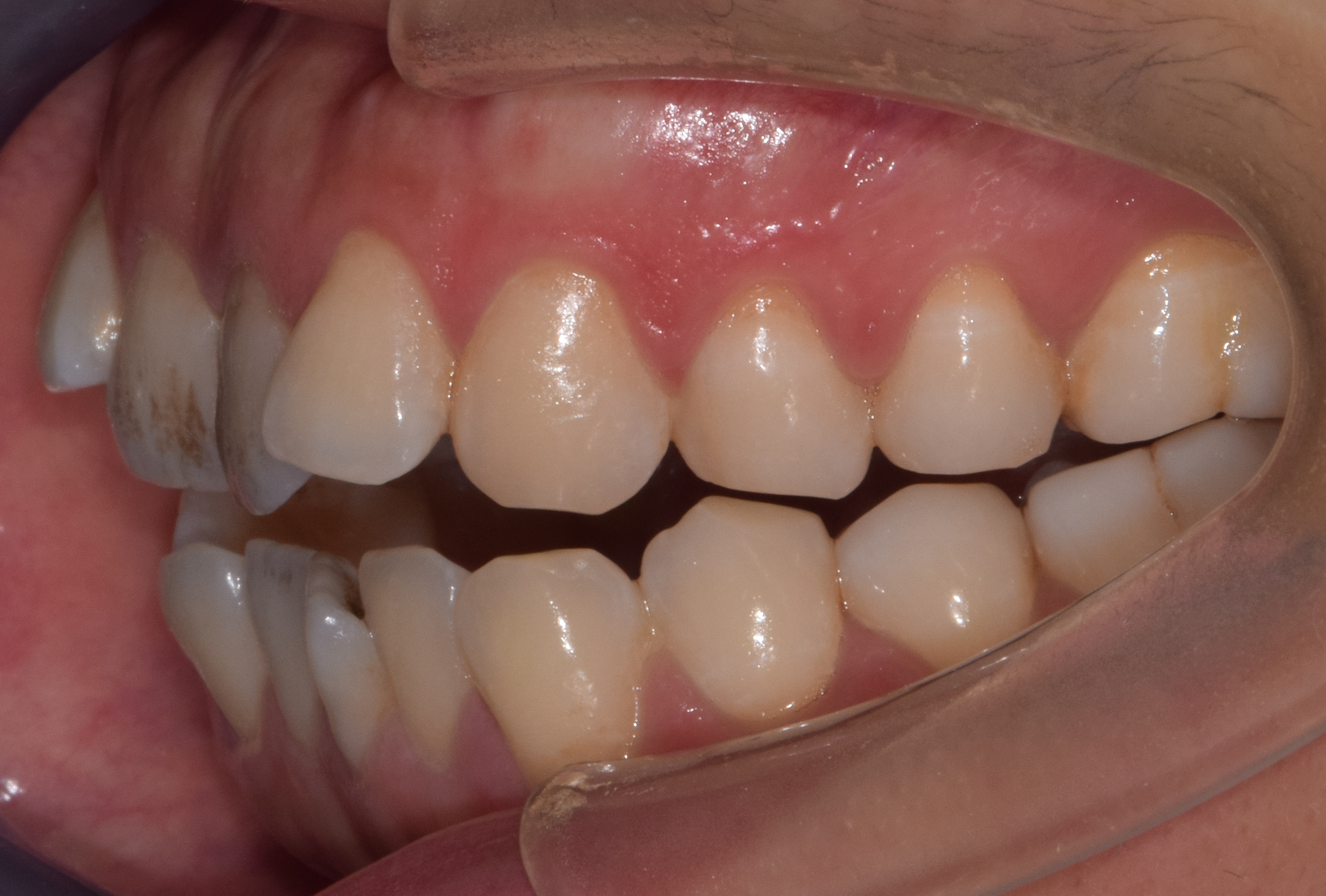 #上海牙齿矫正|面突+前牙区开颌案例⭐舌侧矫正优势！ - 知乎